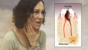 dental abscesses
